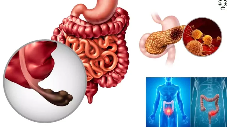 Bowel Cancer and Everything You Need to Know Causes, Prevention, and Key Facts